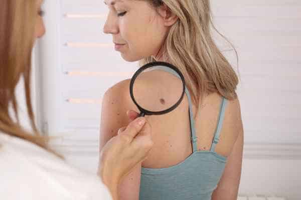 What Are Traditional Skin Lesion Removal Methods Hickstead?