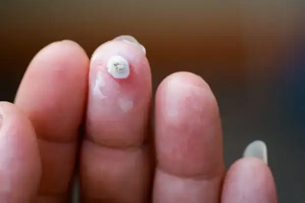 Image of white wart before cryopen treatment Hickstead