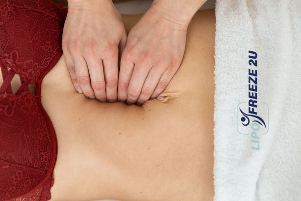 diastasis recti treatment Hickstead