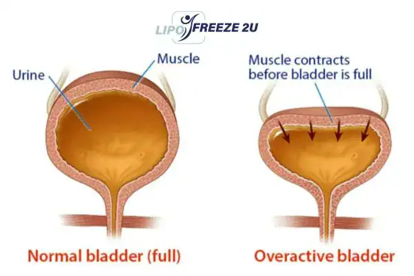diagram of overactive bladder treatment Hickstead