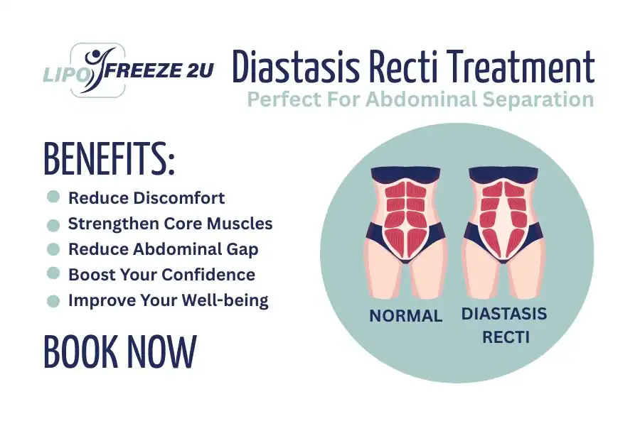 Benefits of body toning treatment Hickstead for Diastasis recti