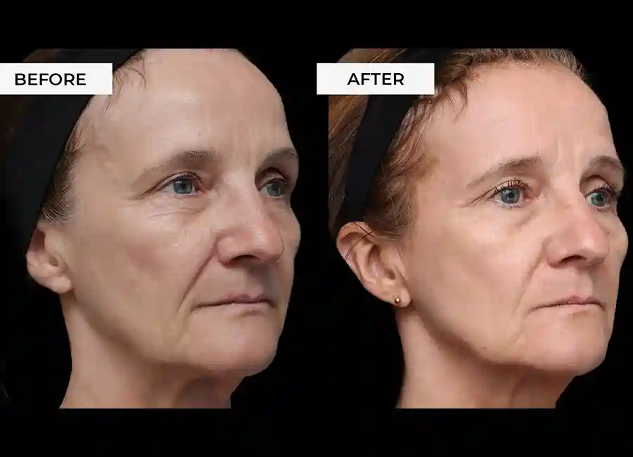 How Many RF Microneedling Sessions Will You Need to See a Difference Hickstead?