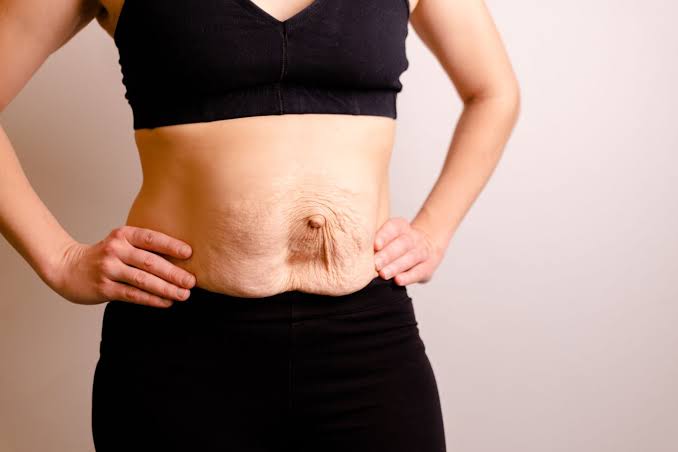 Is Surgery Really the Only Way to Repair Diastasis Recti Hickstead?