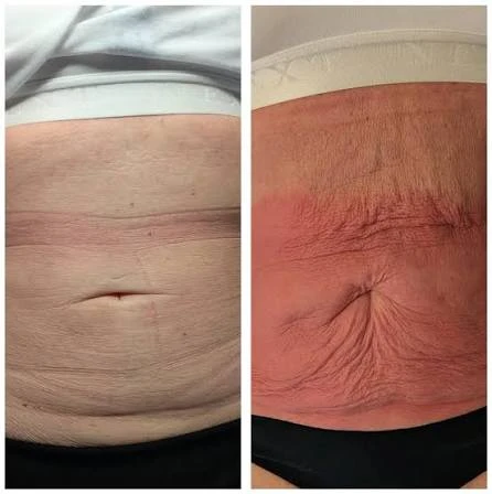 How Does RF Microneedling Improve Crepey, Thin and Uneven Skin Texture Hickstead?