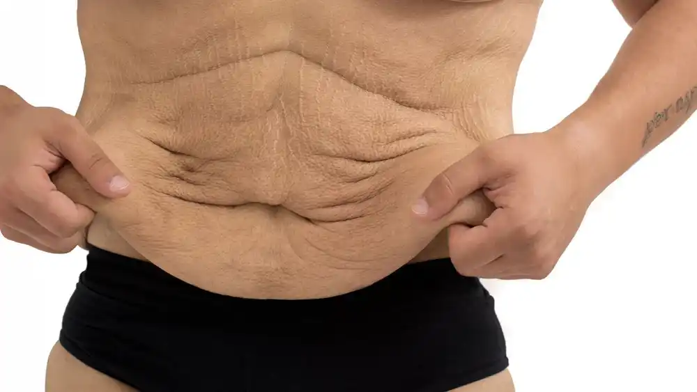 Why Does Weight Loss Medication Leave Some People With Loose or Sagging Skin Hickstead?